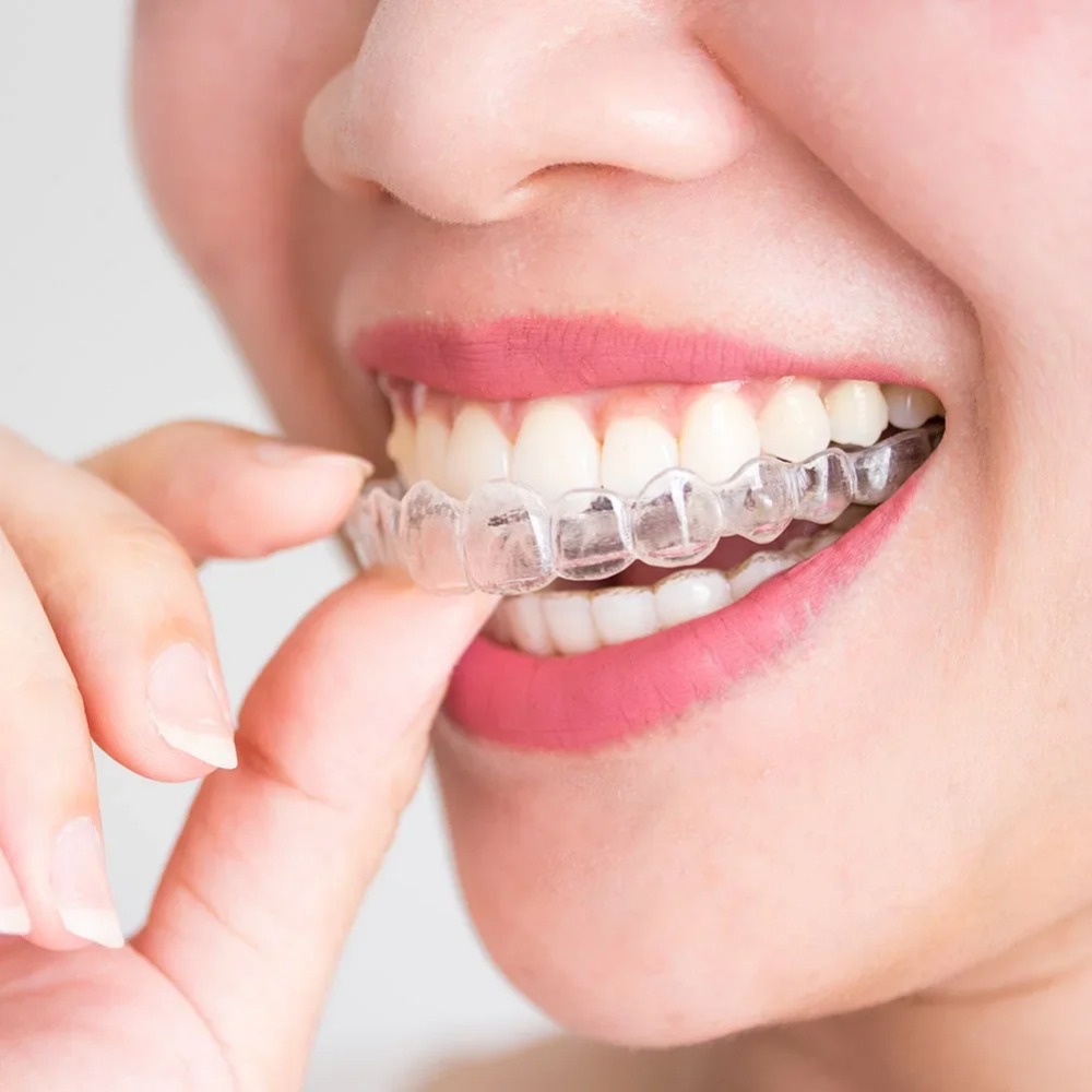 1-4個入りいびき防止歯ぎしり防止睡眠用マウスガードトレイ、 - Teeth Whitening Mouth Guard のレビューと価格
