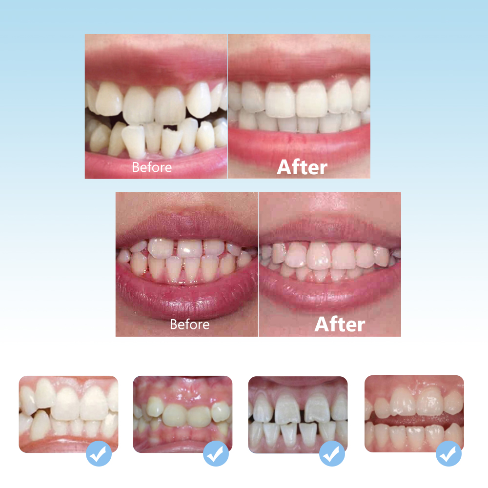 歯列矯正ブレースセット3段階シリコーン調整器歯リナー潤滑剤マ - Teeth Whitening Mouth Guard のレビューと価格