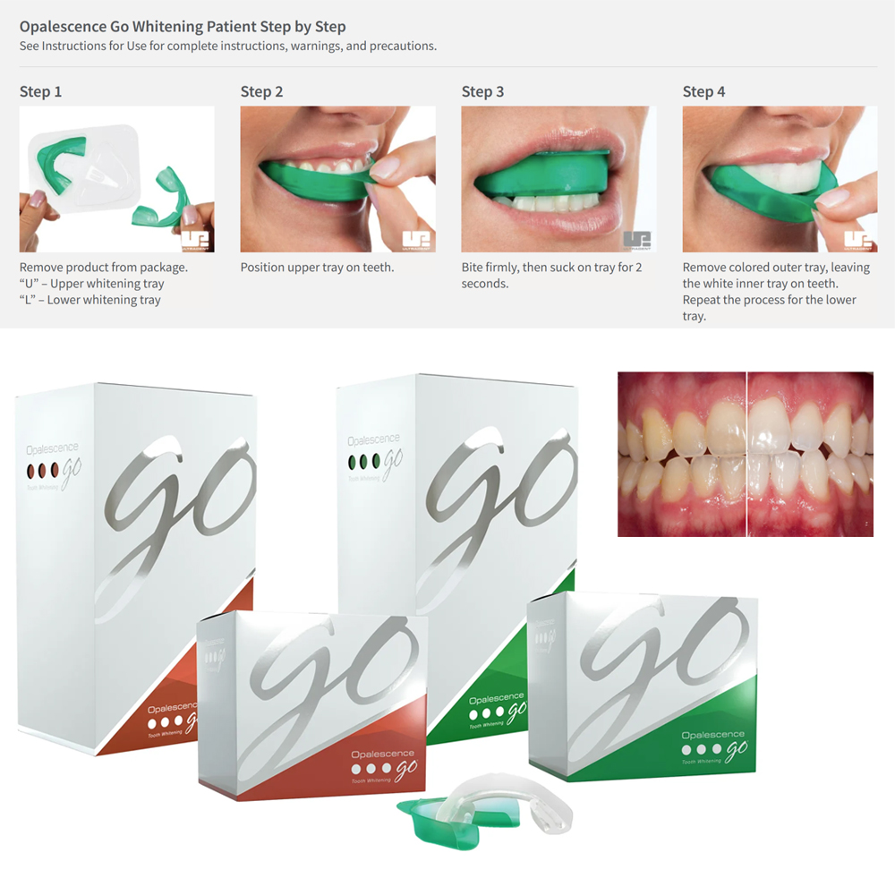 Opalent go歯のホワイトトレイ、お家に詰められた患者 - Teeth Whitening Opalescence Go のレビューと価格