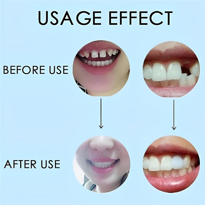 【新商品！ABMK】2ペア、美しい笑顔を取り戻す、ユニバーサ - Teeth Whitening For Braces のレビューと価格